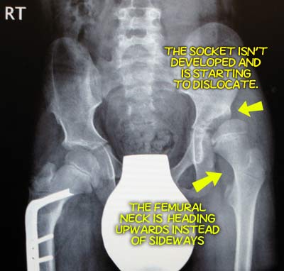 xray before