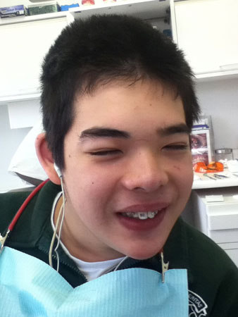 first braces on teeth