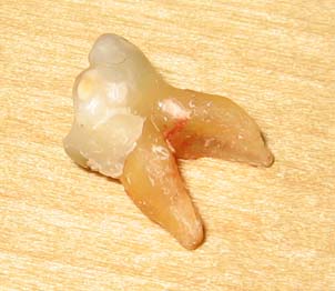Laura's tooth