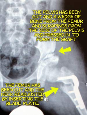 xray postop