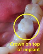 new tooth