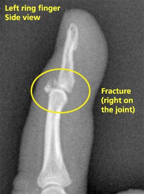 x-ray of Laura's fractured fingertip