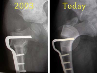 Comparative xrays reveal Jon's fracture