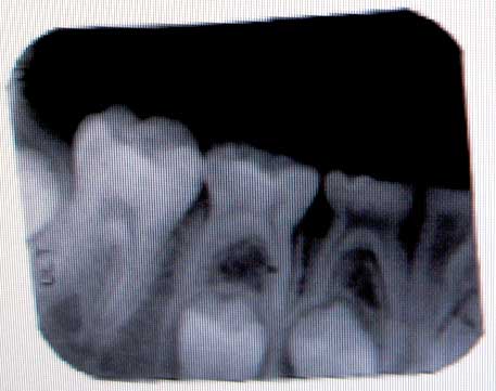 Jon lower molar xrays