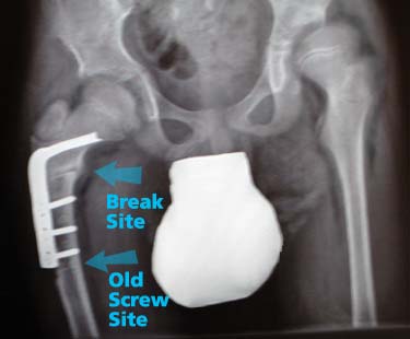 x-ray showing a healing right leg and a poor quality left hip