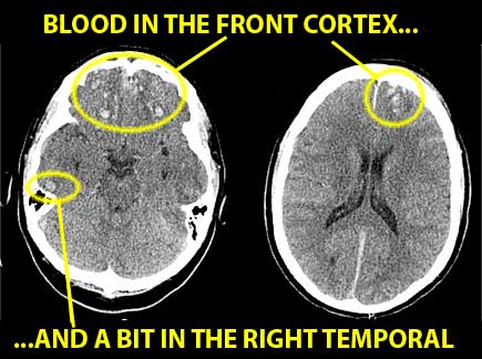 CAT scans of Peter's brain, hours after his fall
