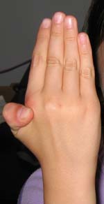 thumb wrapped around hand