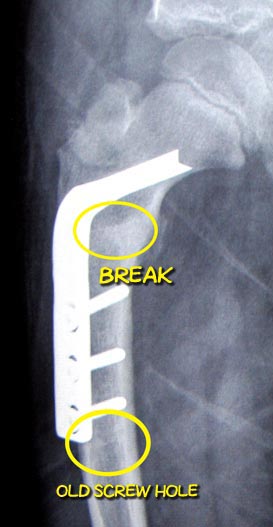 xray of a healed femur with hardware